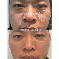 印第安纹剥离微整价格