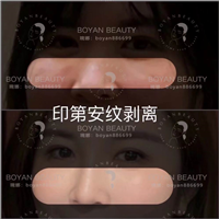 博妍剥离微整