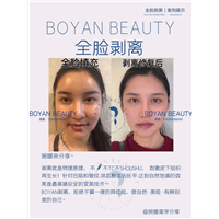 全脸剥离