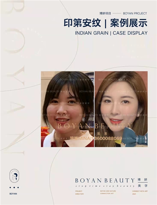 印第安纹剥离