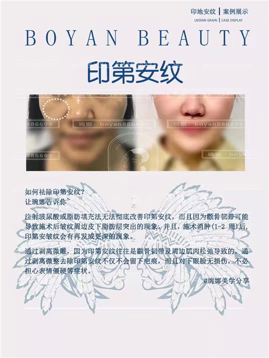如何祛除印第安纹