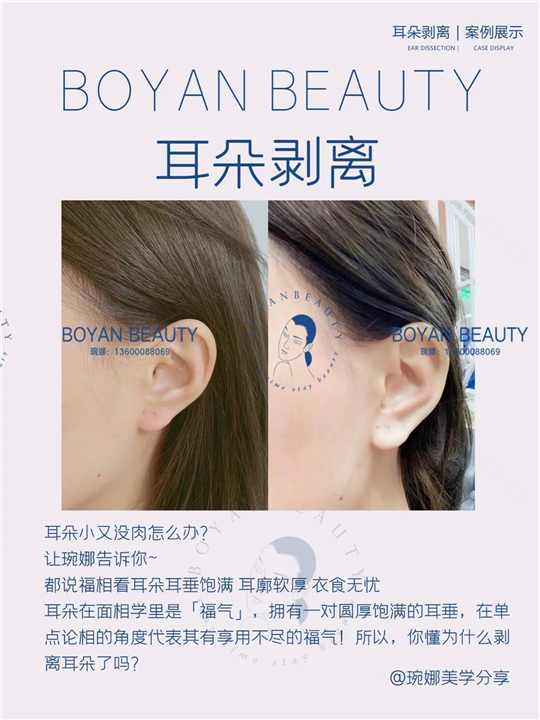 耳朵剥离