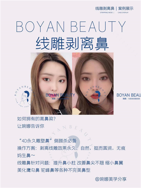 线雕剥离鼻