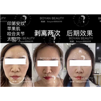 博妍剥离微整