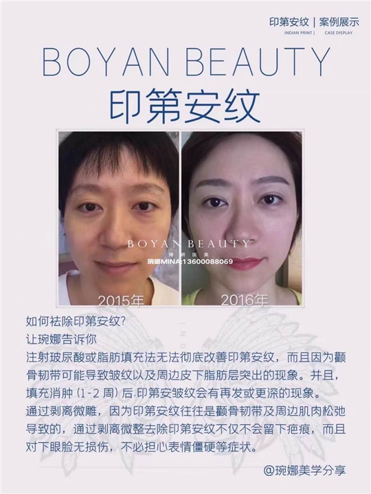 博妍剥离微雕