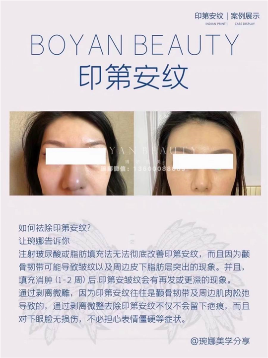 博妍剥离微雕