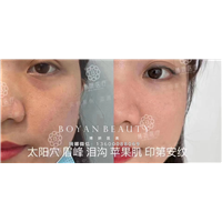 印第安纹的修复方法