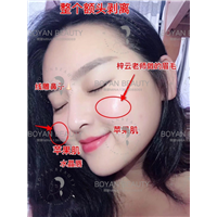 剥离苹果肌