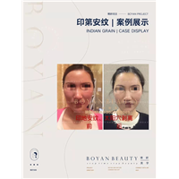 印第安纹剥离