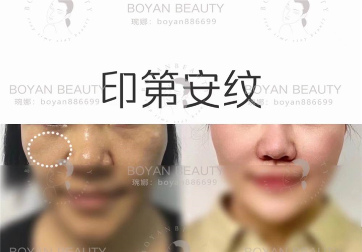 博妍剥离微整