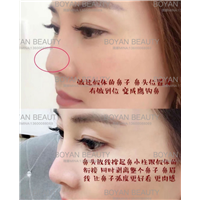 线雕剥离鼻子