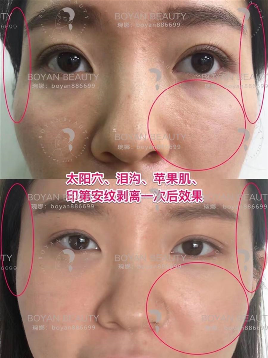 印第安纹剥离