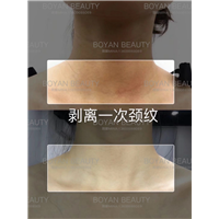 剥离颈纹
