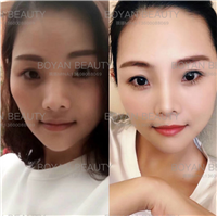 剥离咬合关节