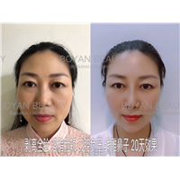 剥离微雕