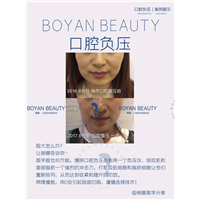 口腔负压
