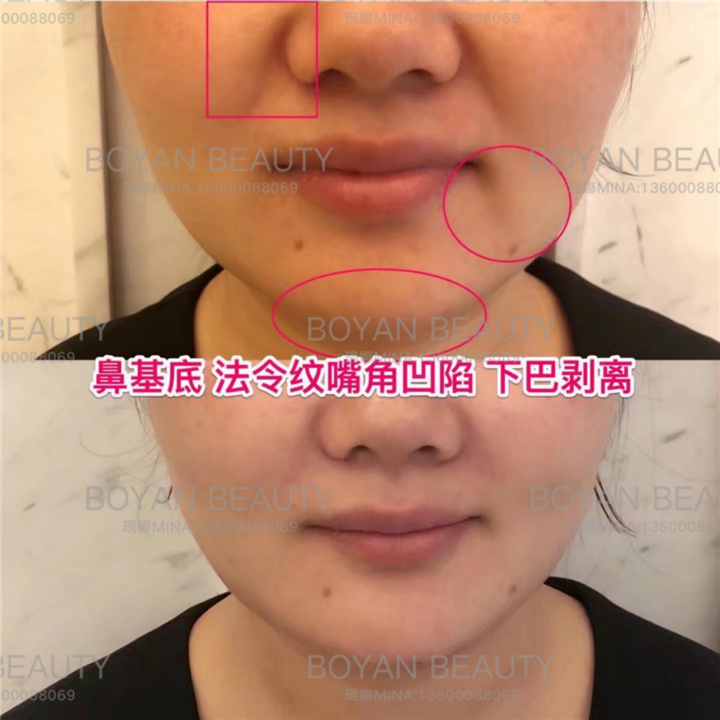 剥离嘴角凹陷