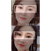 剥离卧蚕