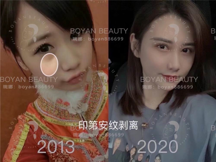 印第安纹剥离