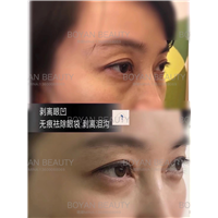 剥离眼凹