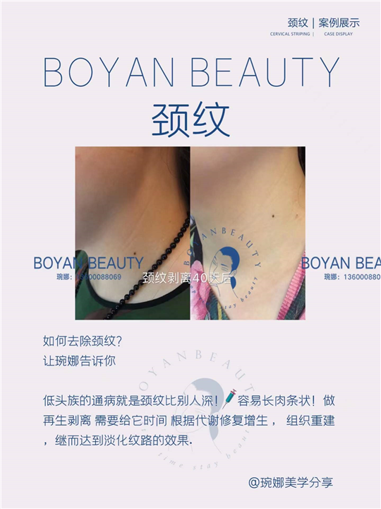 剥离颈纹