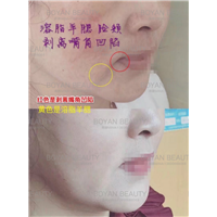 剥离嘴角凹陷
