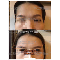 剥离太阳穴