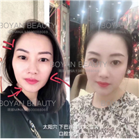 剥离咬合关节