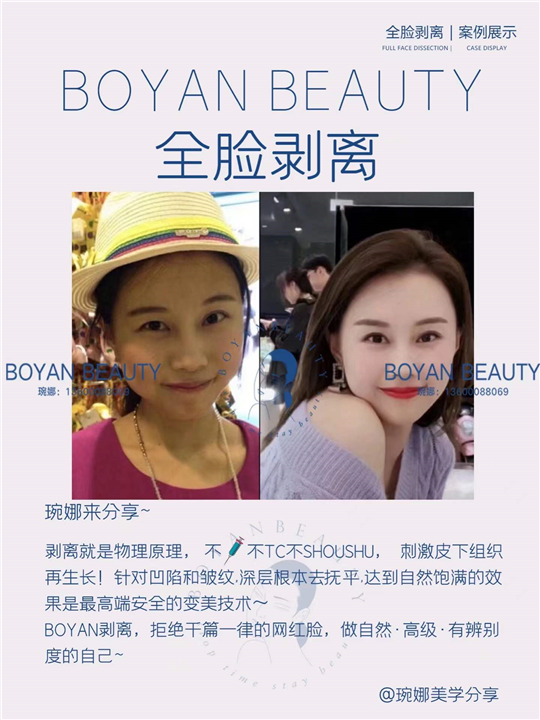 全脸剥离