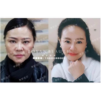 博妍剥离微整