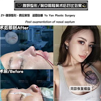 广州雅妍鼻中隔整形价格 
