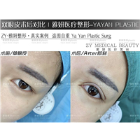 广州双眼皮整形价格 