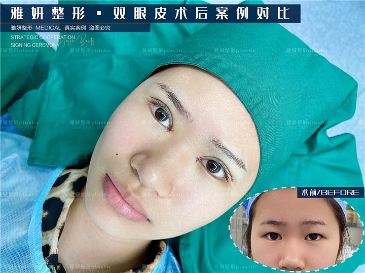 雅妍双眼皮整形价格