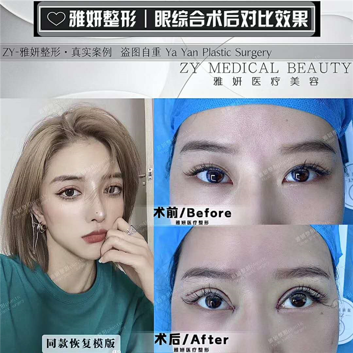 雅妍双眼皮整形价格 