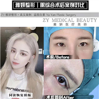 雅妍眼综合整形多少钱 