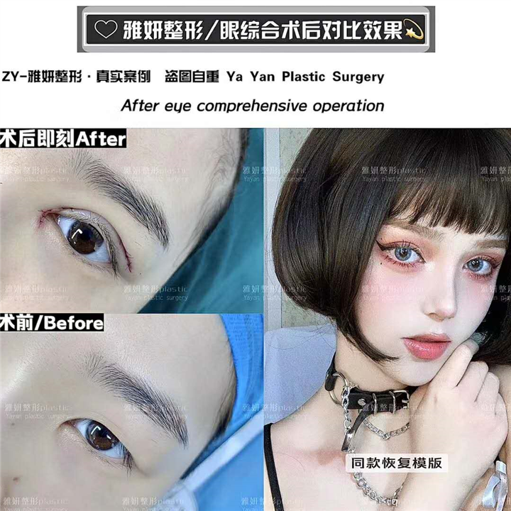 雅妍整形双眼皮价格 