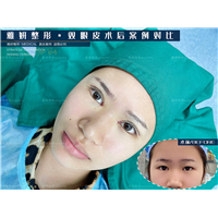 雅妍双眼皮整形价格