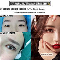 雅妍眼综合整形价格 