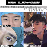 雅妍男士双眼皮价格 