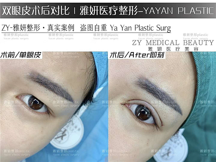广州双眼皮整形价格 