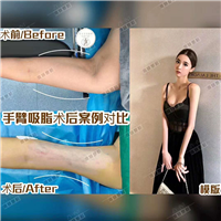 雅妍手臂吸脂费用 