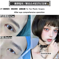 雅妍整形双眼皮价格 