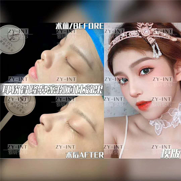 广州雅妍耳软骨鼻综合 