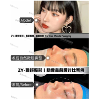雅妍肋骨鼻整形 