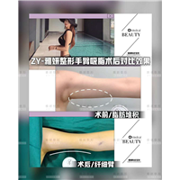 雅妍手臂吸脂多少钱 