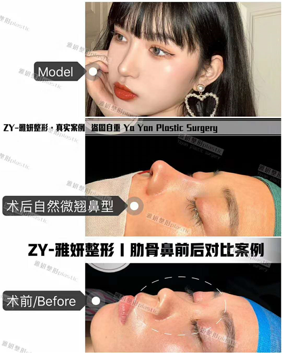 雅妍肋骨鼻整形 