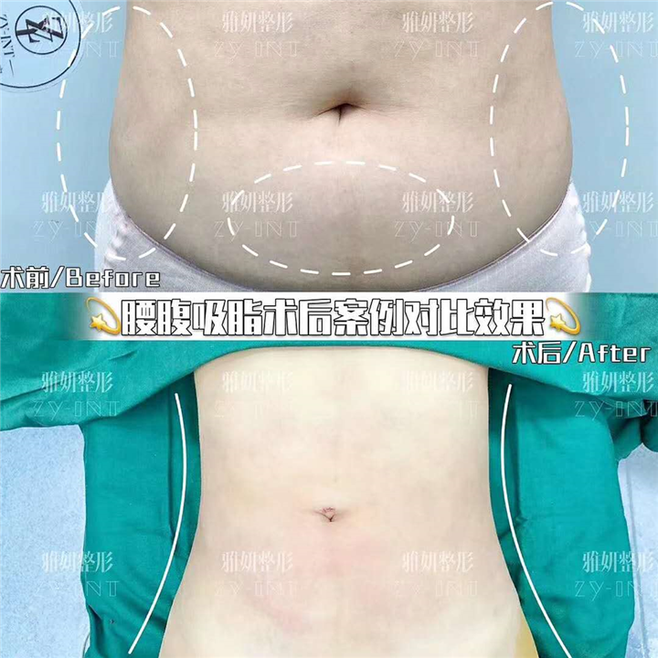 雅妍腰腹吸脂多少钱 