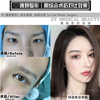 广州眼综合整形价格 