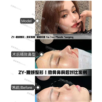 雅妍整形肋骨鼻价格 