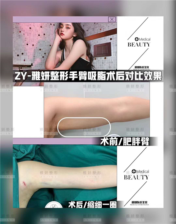 雅妍手臂吸脂价格 